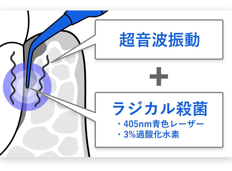 歯科治療における作用機序の図解。歯周ポケットに治療器具の先端を挿入しているイラスト。「超音波振動」と「ラジカル殺菌(405nm青色レーザー、3%過酸化水素)」の掛け合わせによる治療効果を示しています。